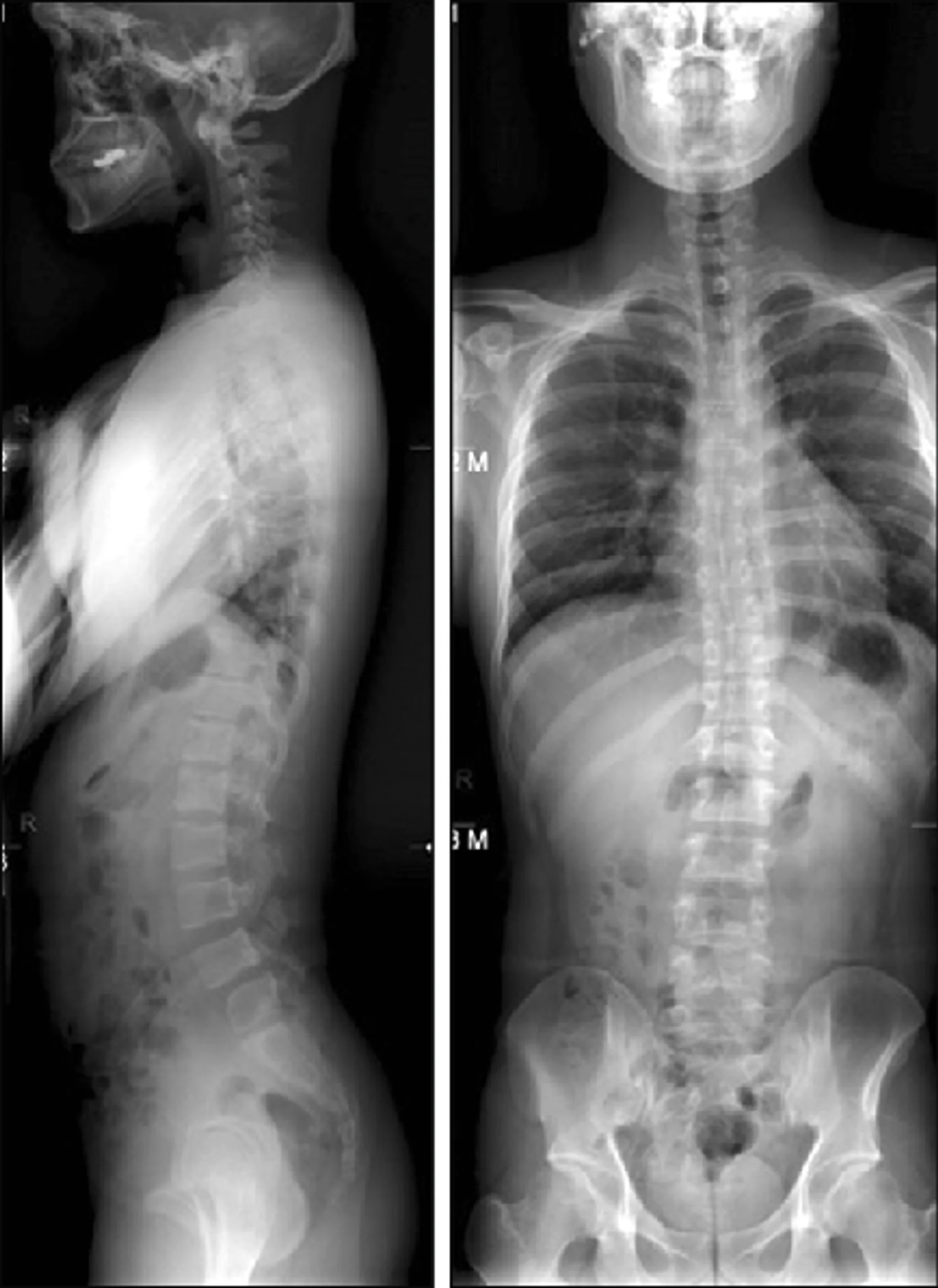 Before and after spinal X-ray showing measurable structural correction