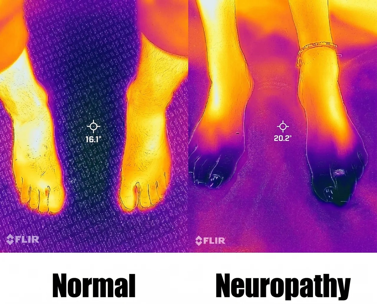 Thermography scan showing nerve dysfunction (red/hot) compared to healthy nerve function (blue/cool)